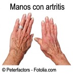 D artritis