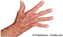 D artritisreumatoide