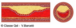 D ateroma