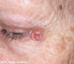D carcinomabasocelular