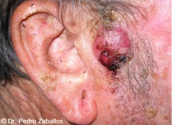 D carcinomaespinocelular