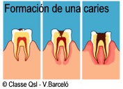 D caries