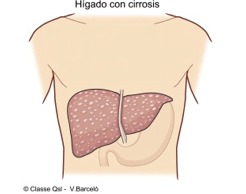 D cirrosis