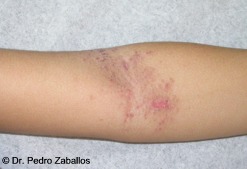 D dermatitisatopica