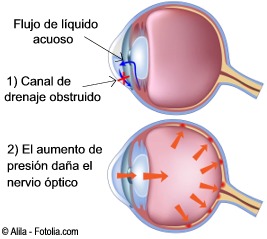 D glaucoma