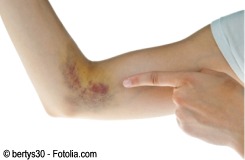 D hematoma