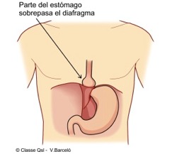D herniahiato