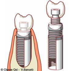 D implantedental