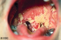 D micosis