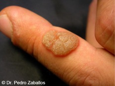 D papiloma