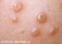 D pustula