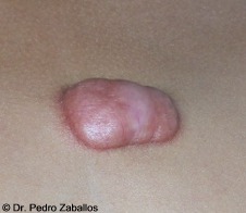 D queloide