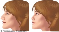 D rinoplastia