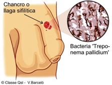 Que es la enfermedad de sifilis sintomas