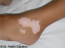 D vitiligo