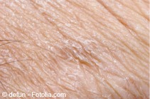 D xerosis
