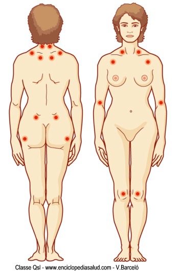 Zonas del cuerpo relacionadas con la fibromialgia
