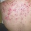 I acne
