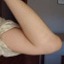 I bursitis