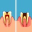 I caries