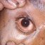 I conjuntivitis