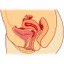 I endometriosis