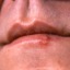I herpes
