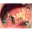 I micosis
