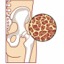 I osteoporosis