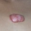 I queloide