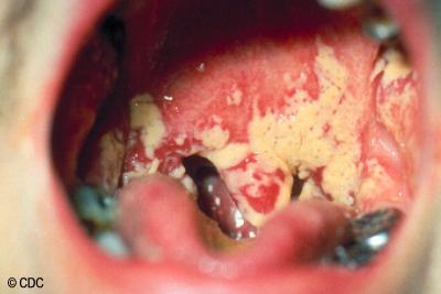 Micosis en la boca