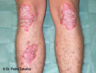 Psoriasis