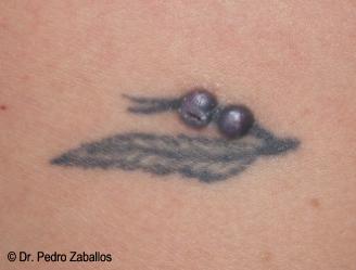 Reacción alergica provocada por un tatuaje