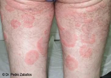 Urticaria