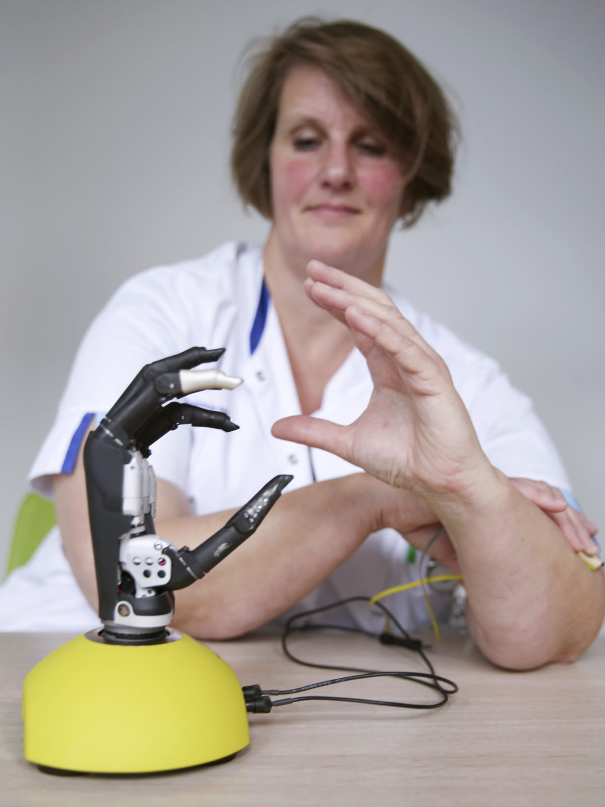 reportage protheses Bionische hand 1 – Sanne