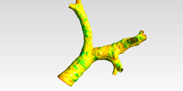 Human Trachea CFD Analysis