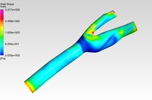 Human-Carotid-Artery-Bifurcation-CFD-Simulation-Wall-Shear-Stress-Contour-FetchCFD-Image.PNG - High-quality image for the Carotid bifurcation cfd simulation project