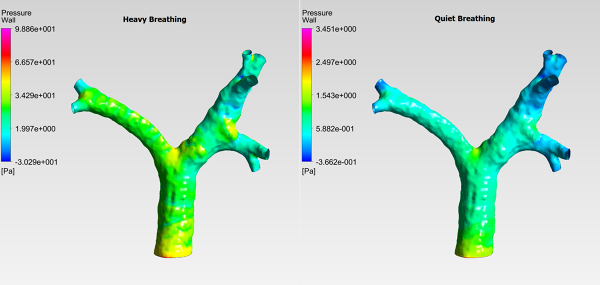 Human-Trachea-CFD-Analysis-Pressure-Contour-Heavy-vs-Quiet-Breathing-Comparison-FetchCFD-Image.png - High-quality image for the Human Trachea CFD Analysis project