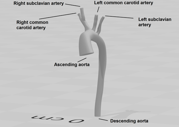 Human-Aortic-Arch-0075-1001-CFD-Analysis-Geometry-FetchCFD-Image.PNG - High-quality image for the Patient-Specific Aortic Arch CFD Analysis project