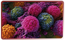 Des résultats en demi-teinte pour le ciblage de GSK3β en association avec gemcitabine/nab-paclitaxel