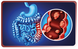 Les agonistes du récepteur de GLP1 : un rôle protecteur vis-à-vis du cancer colorectal supérieur à celui de l’aspirine