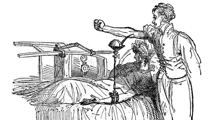 James Blundells Illustration aus "The Lancet", 1828