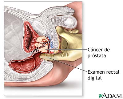 Cuando tiene un absceso perianal, tiene un dolor anke en la próstata.