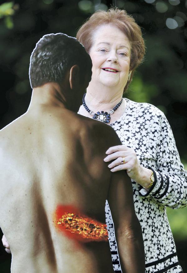 Beware of the signs of shingles