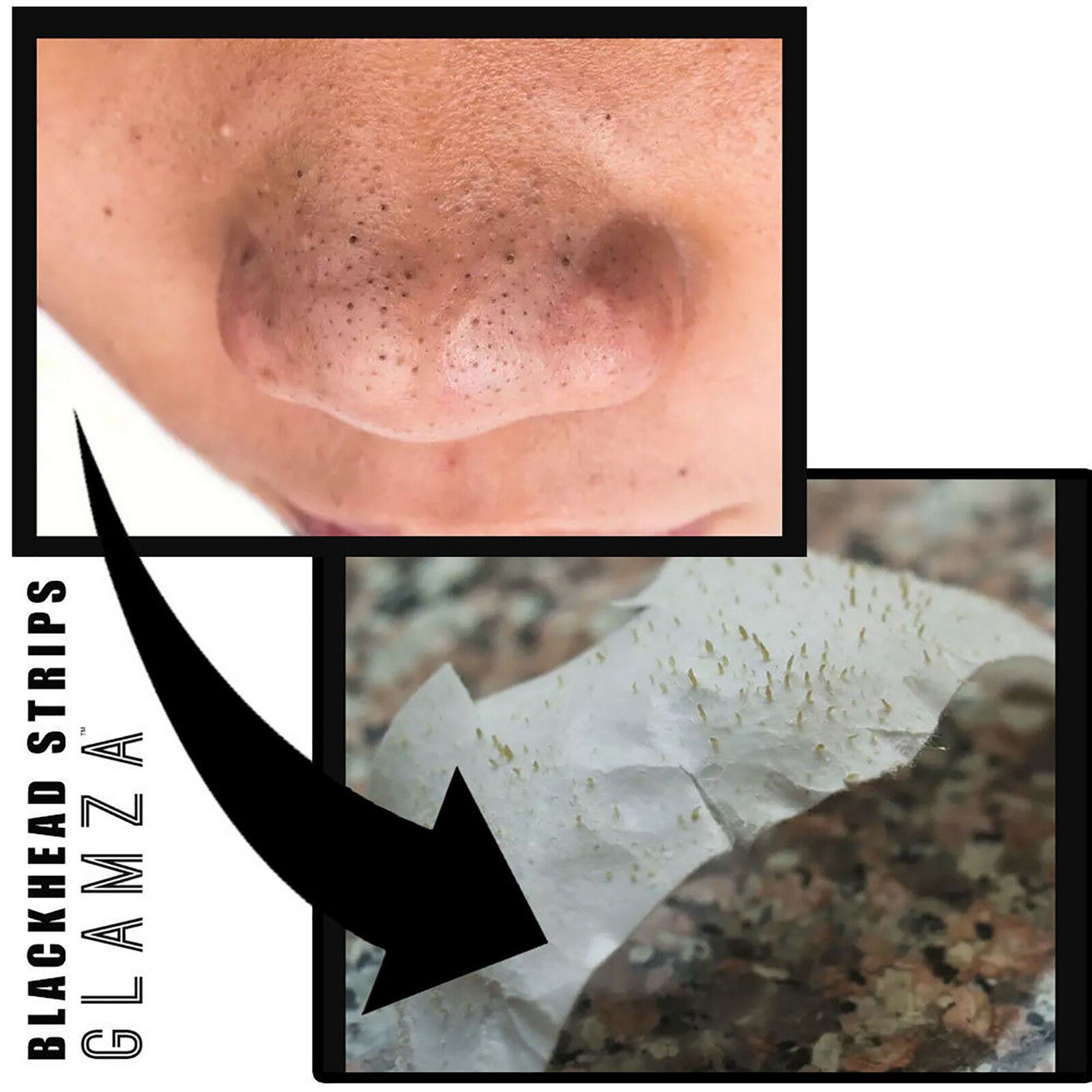 Big Blackheads: The Ultimate Step By Step Removal Guide - i4b9bn0