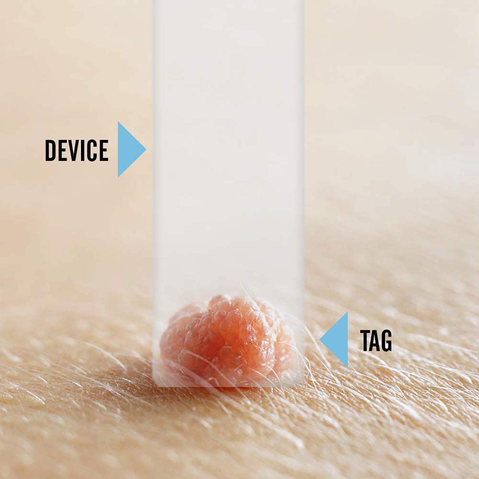 Tagcure Skin Tag DIY Removal Kit 3 Step Safe Permanent Treatment