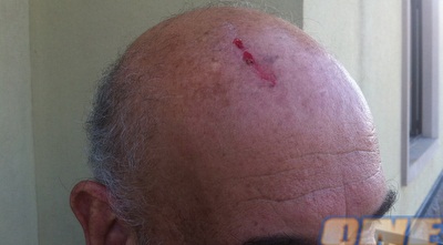 אהרון ריינמן והפציעה בראש 