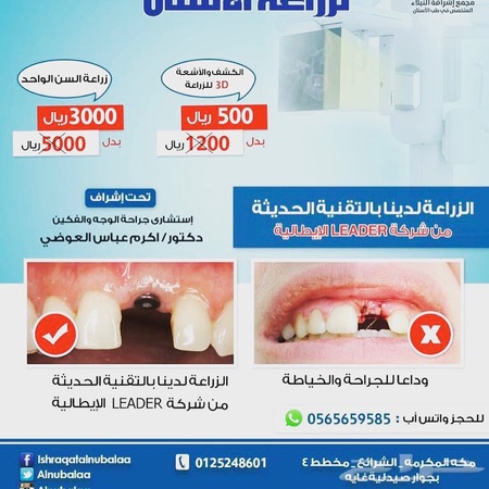أقوي عروض زراعه الاسنان في مكه