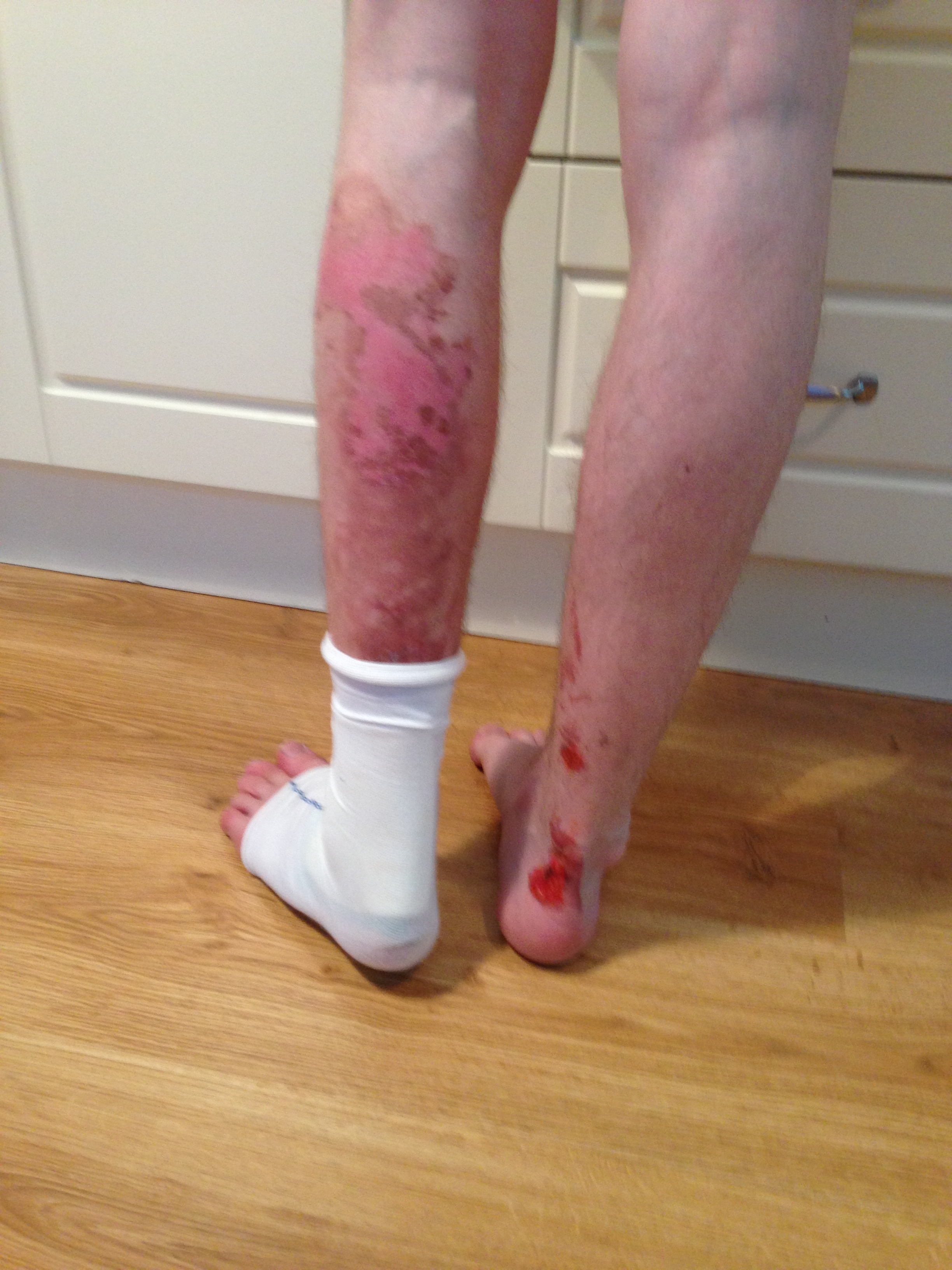 Greene King hit with £140,000 fine after waiter severely scalded