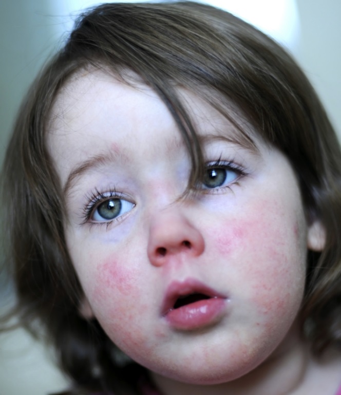 Scarlet fever cases double across Reading and surrounding towns